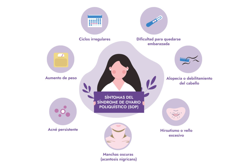 Síntomas más comunes del síndrome de ovario poliquístico en mujeres